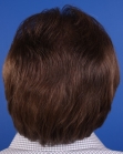 After Hair Transplant&nbsp;2 Sessions (Areas)